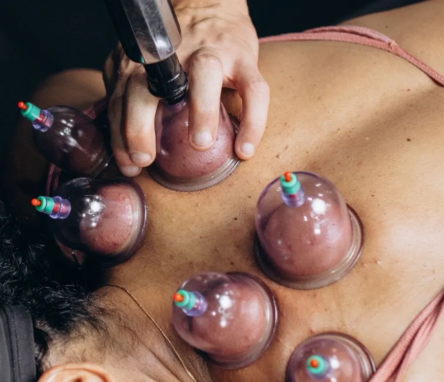 Ventouses de hijama posées sur le dos d'un patient